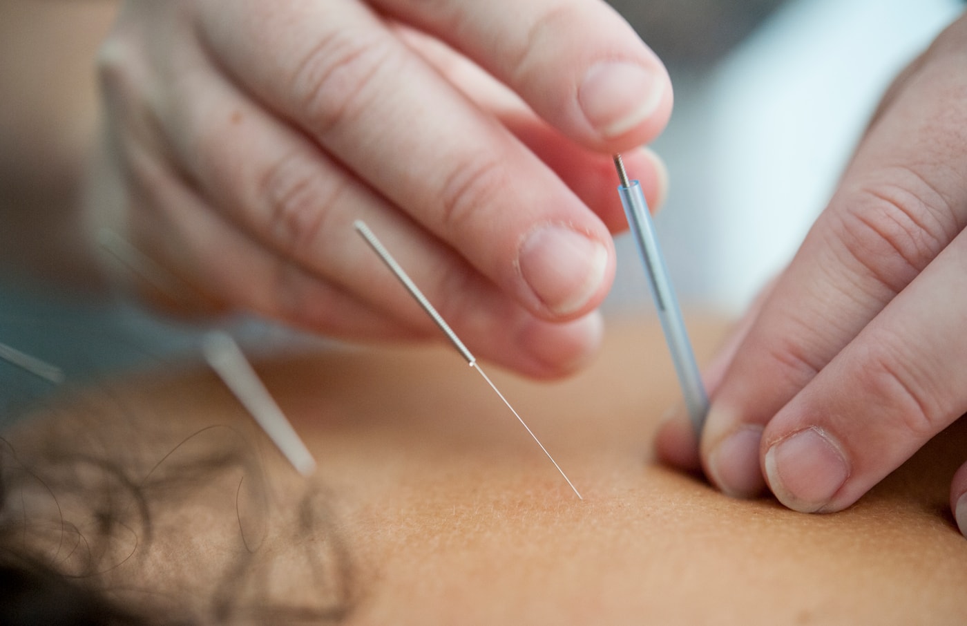 Close-up of a practitioner preparing a needle during an acupuncture session.